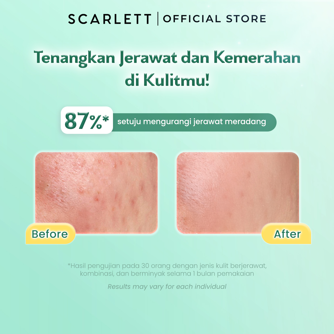 SCARLETT Twinpack Low pH Acne Peace Gel Cleanser-Facial Wash Gentle Sabun Cuci Muka Low pH (100ml x 2)