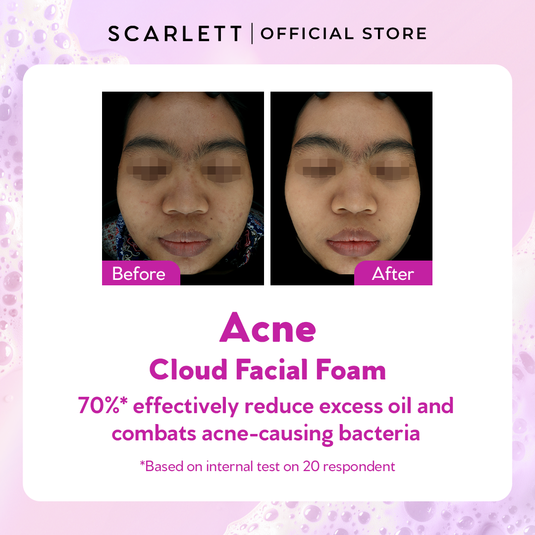 Scarlett Acne Cloud Facial Foam