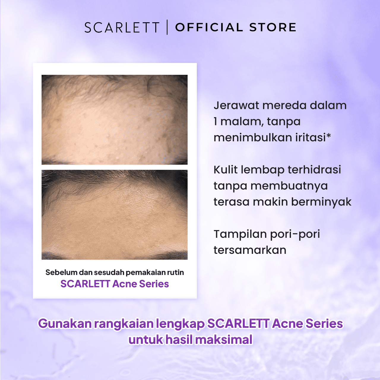 Scarlett Combo Acne Cream melembabkan dan merawat kulit berjerawat [Acne Day Cream + Night Cream]