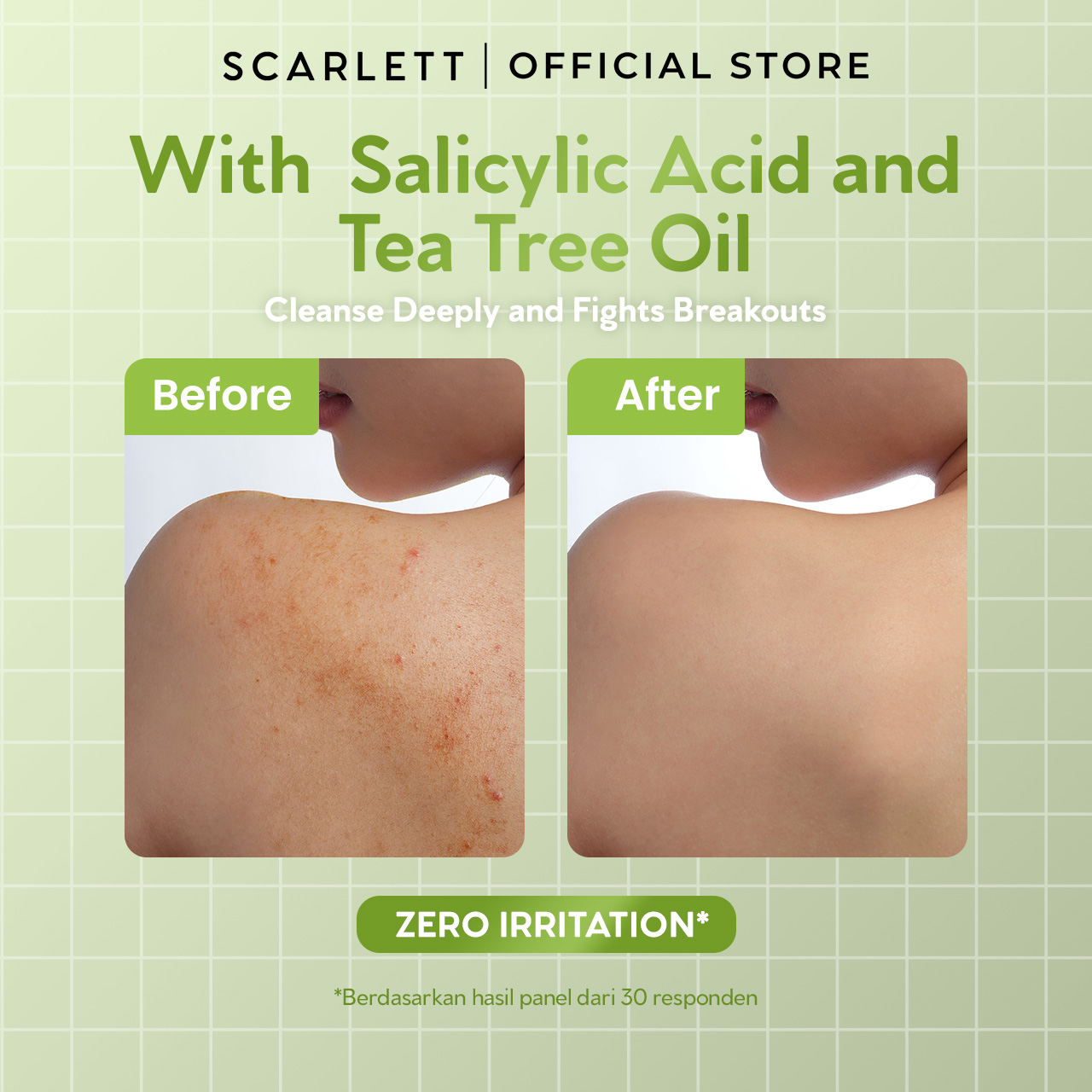 SCARLETT Perfumed Shower Serum 400ml – Acne Care | Anti-Acne Shower Gel dengan Salicylic Acid & Tea Tree Oil | Sabun Mandi Cair untuk Jerawat Punggung & Dada, Membersihkan Pori, Menenangkan Kulit Berjerawat | Shower Serum dengan Wangi Parfum Mewah Kelas Dunia