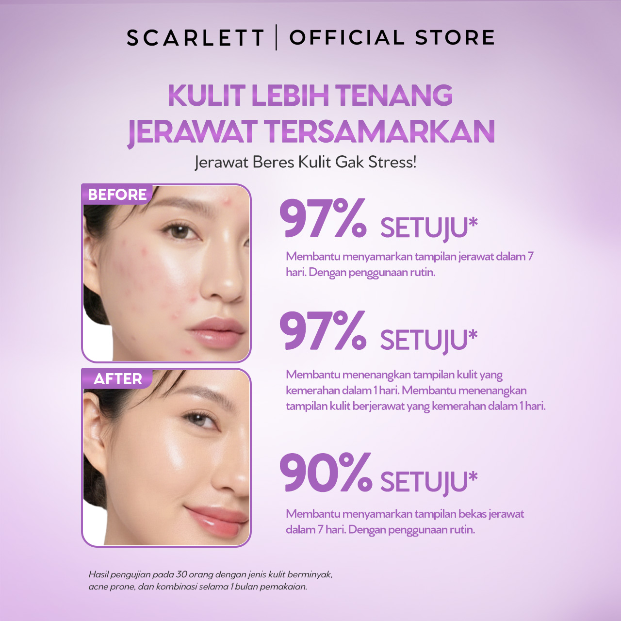 NEW FORMULA Scarlett Acne Serum Azeclair, 2% Salicylic Acid & Niacinamide - Serum Jerawat , Melawan Jerawat , Membantu Menyamarkan Tampilan Jerawat, Cocok Untuk Kulit Berjerawat
